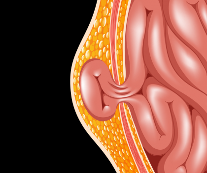 Mide Fıtığı (Hiatal Herni): Ne Zaman Ameliyat Gerekir?