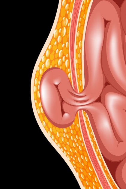 Mide Fıtığı (Hiatal Herni): Ne Zaman Ameliyat Gerekir?
