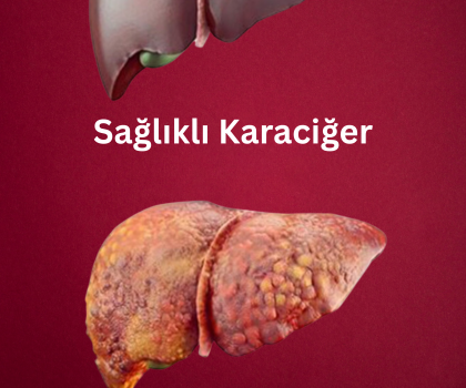 Hepatit C ve Siroz İlişkisi: Sessiz İlerleyen Bir Tehlike
