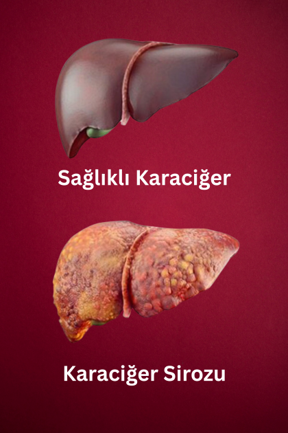Hepatit C ve Siroz İlişkisi: Sessiz İlerleyen Bir Tehlike