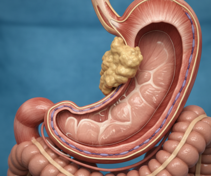 GIST (Gastrointestinal Stromal Tümörler) Nedir?